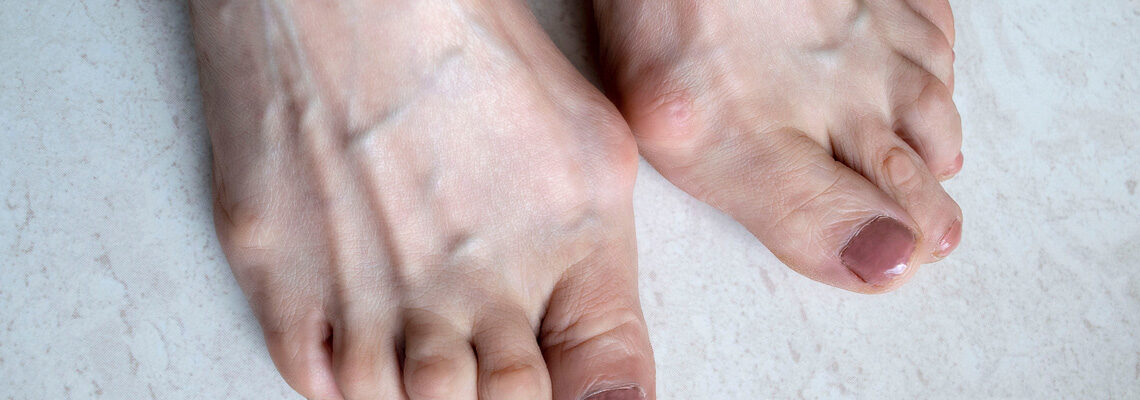 Hallux valgus