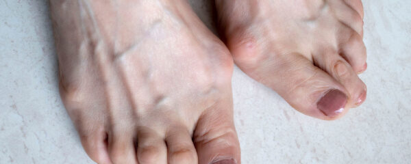 Hallux valgus